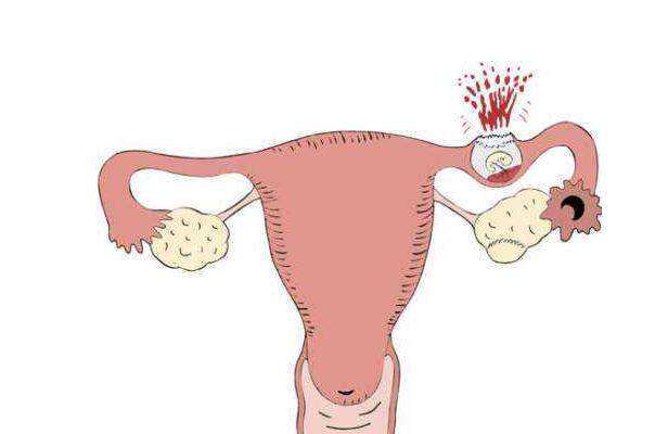 输卵管堵塞的预防和治疗指南，助您安心备孕